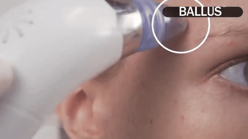 5-Level Pore Vacuum Blackhead Remover – جهاز شفط المسام وإزالة الرؤوس السوداء